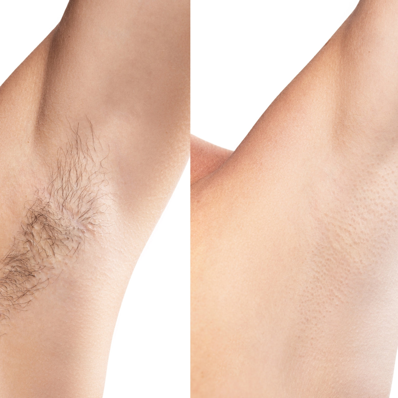 Deine Beautybar Hairfree System 10 x 5 Zonen